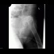 Coxarthrosis, advanced: X-ray - Plain radiograph